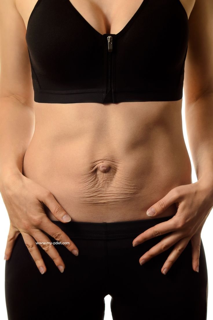 Diastasis Recti